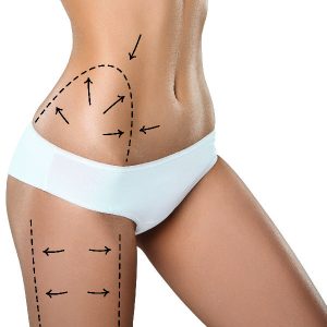 lipoescultura, enxerto de gordura, remodelação corporal
