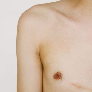 mamoplastia masculinizadora, cirurgia trans masculino, mastectomia masculinizadora, homem trans